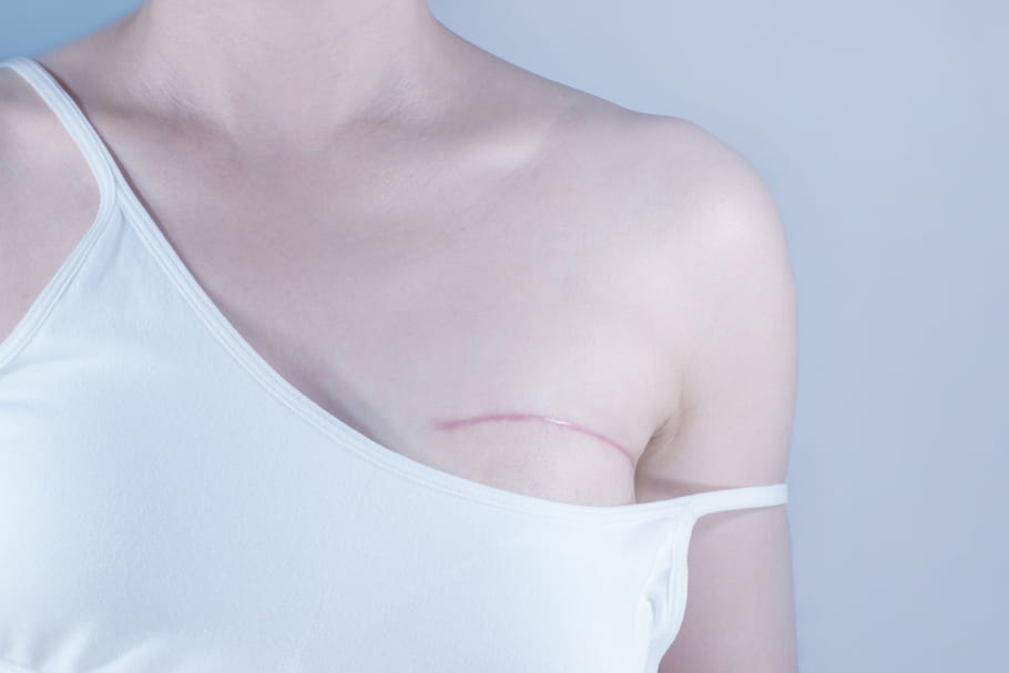 Reconstruction mammaire et cancer : prothèse, coût, remboursement