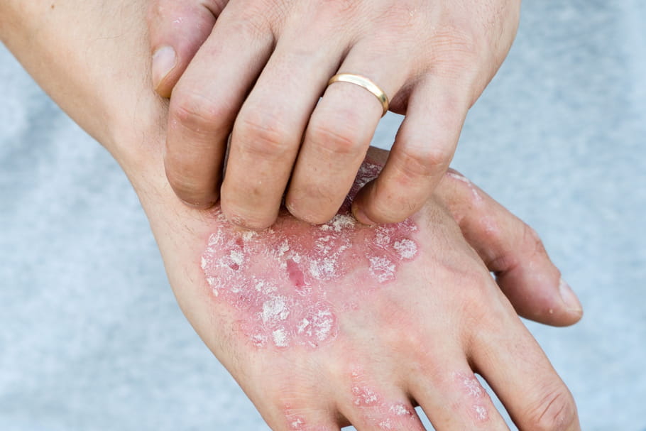 Psoriasis en goutte : causes, photos, traitements efficaces