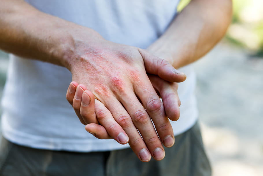 Rhumatisme psoriasique : causes, diagnostic, traitement