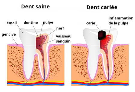 carie dentaire