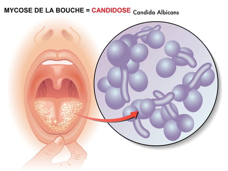 schema-candidose-mycose-buccale