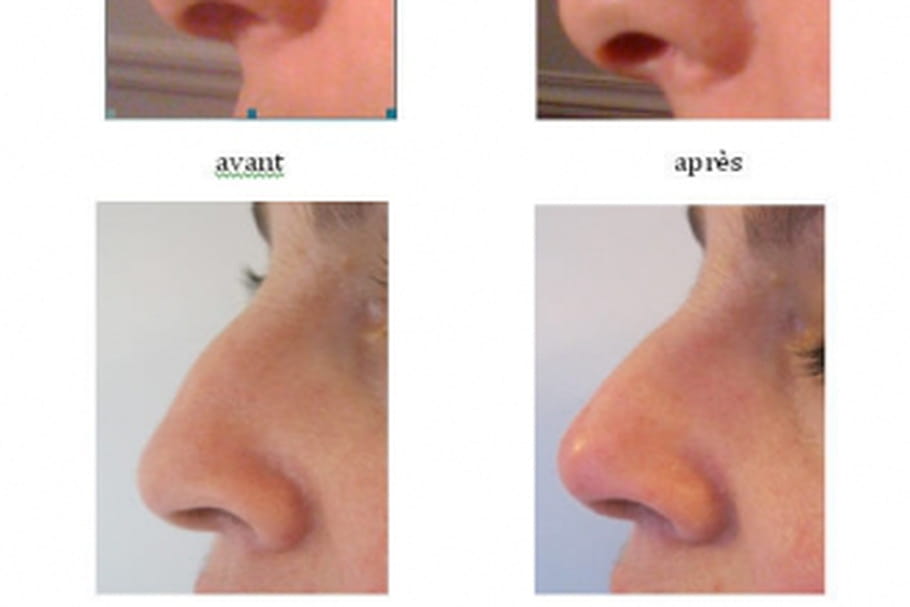Zoom sur les rhinoplasties sans bistouri
