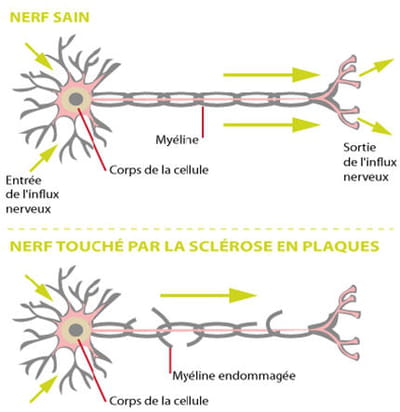 lors des poussées, la myéline, qui entour le nerf, se trouve détruite pas
