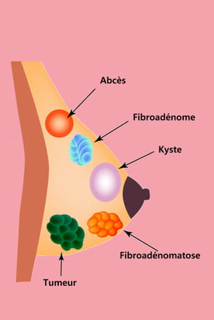 Douleur Et Boule Dans Le Sein Abces Kyste Fibroadenome