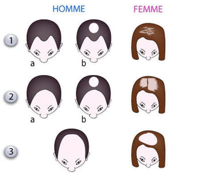les hommes et les femmes ne se dégarnissent pas de la même manière.'chez