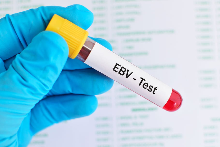 Virus d'Epstein-Barr : sérologie, traitement, conséquences