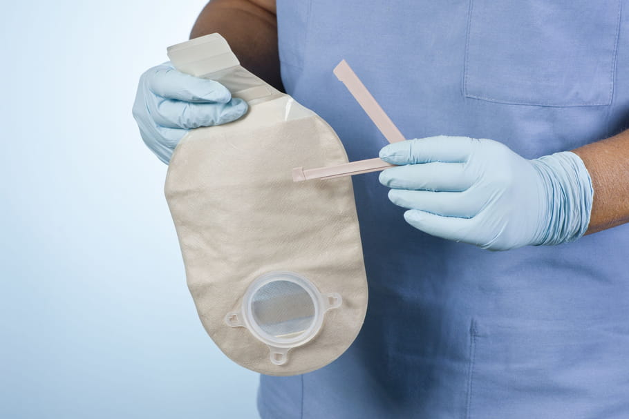 Colostomie : indications, poche, temporaire ou définitive ?