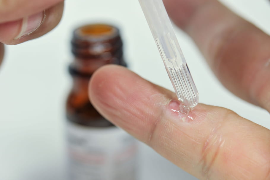 Comment soigner les verrues sans douleur ?