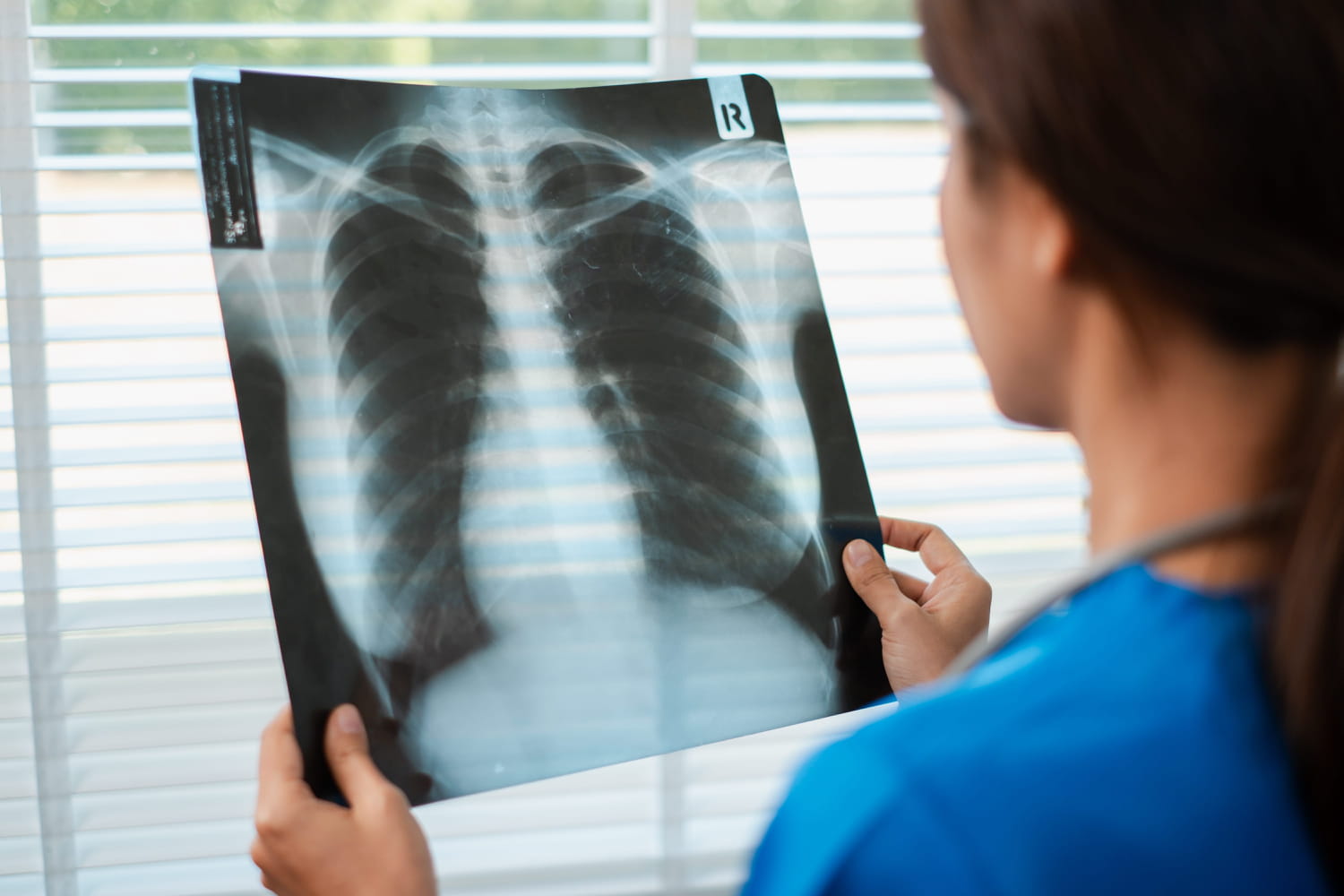 7 warning symptoms of lung cancer in women 7 warning symptoms of lung cancer in women