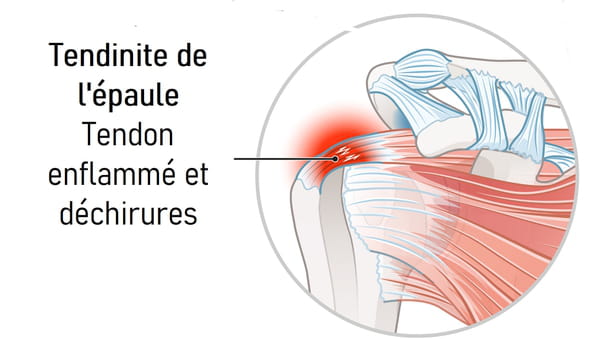 Schéma tendinite épaule