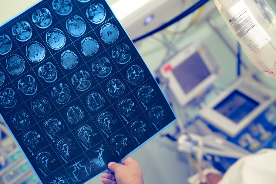 Coronavirus et cerveau : les atteintes neurologiques à l'étude