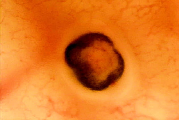 Apparition de la vue du f&oelig;tus