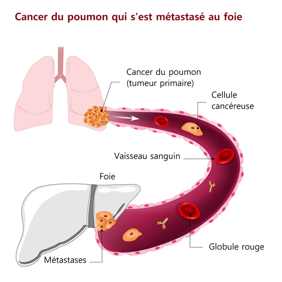 survie cancer prostate métastase osseuse