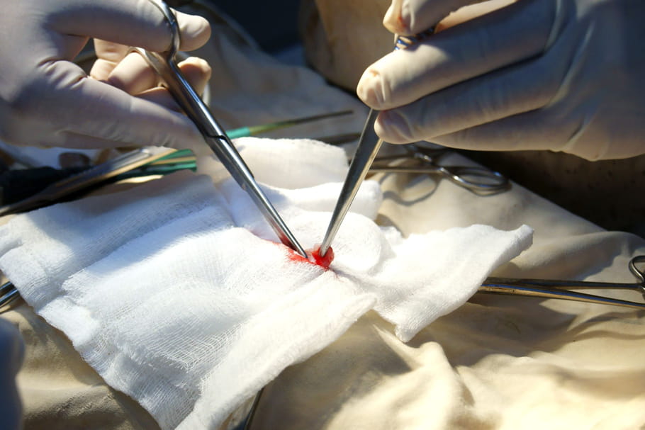 Laparotomie : indications, complications, convalescence