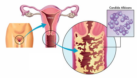 Schéma d'une mycose vaginale
