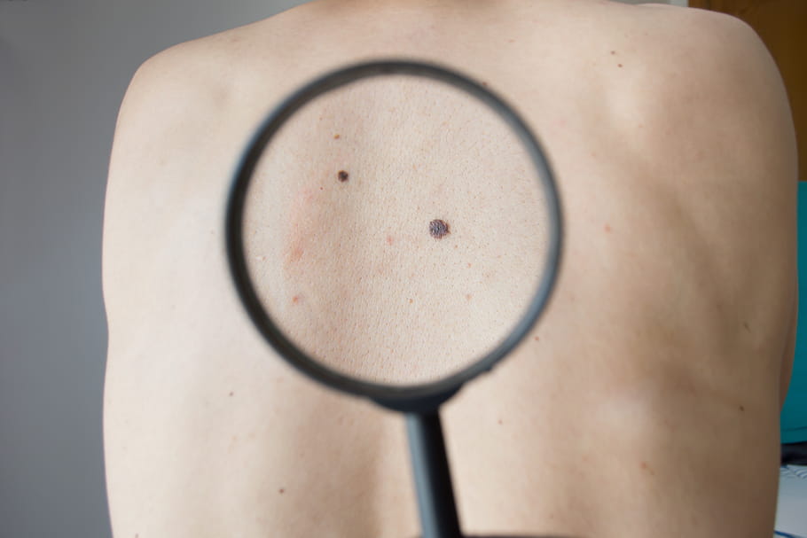 Les taches suspectes d'un cancer de la peau en photos