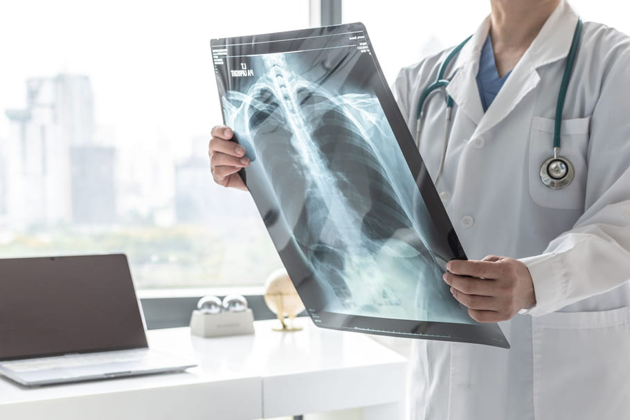 Cancer du médiastin : causes, âge, symptômes, guérison