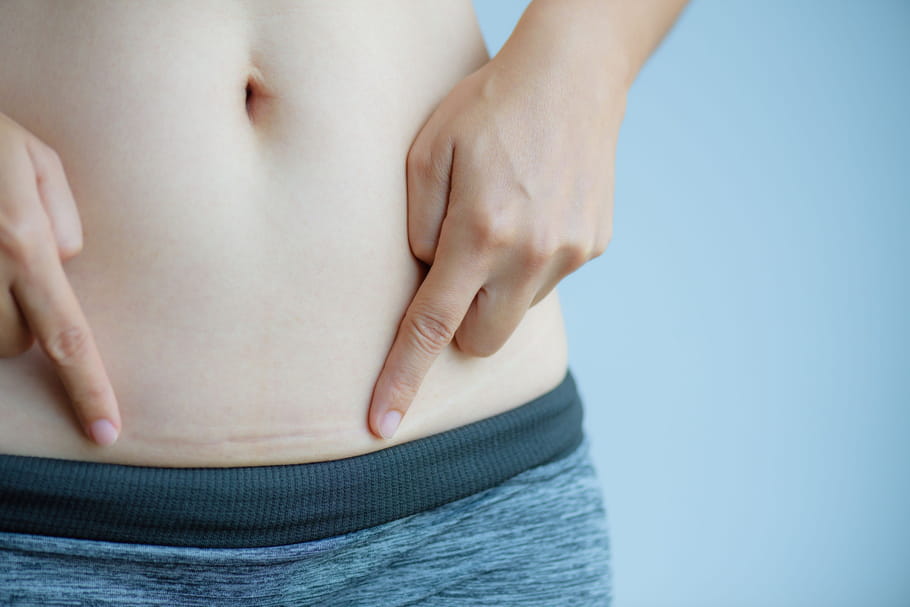 Cicatrices : chéloïdes, hypertrophiques, comment les enlever ?