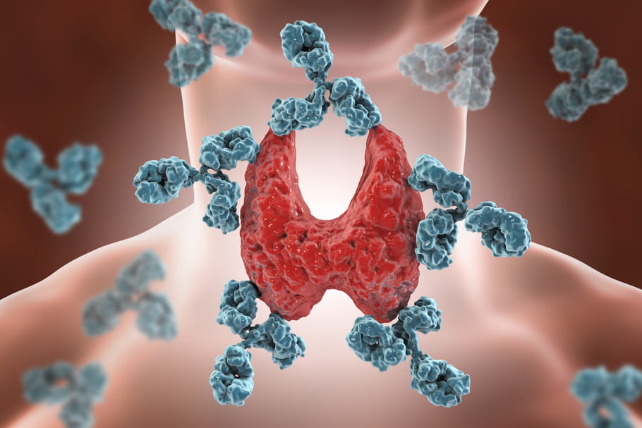 Thyroidite auto-immune : reconnaître les symptômes et la soigner