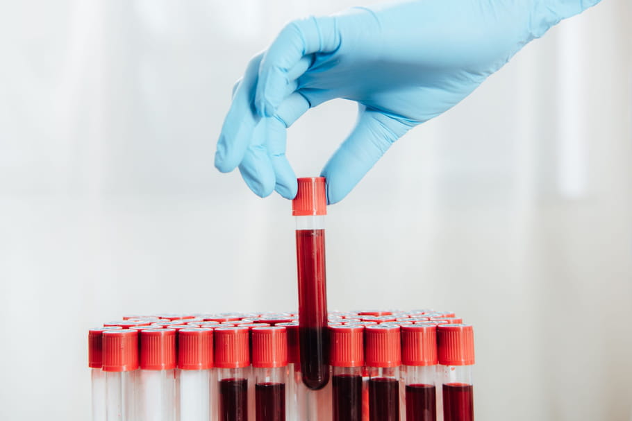 Immunoglobuline M - IgM : basse, élevée, causes, que faire ?