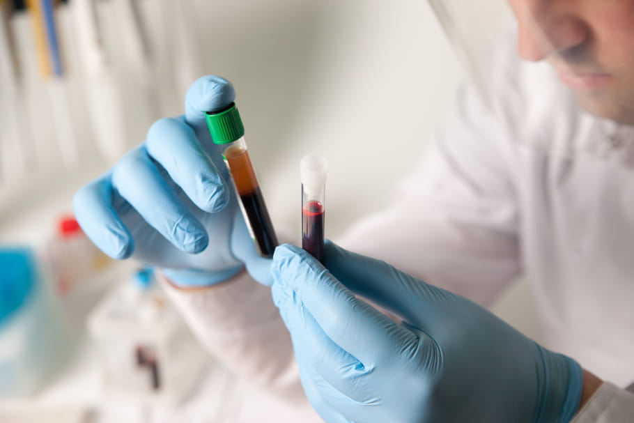 Facteur rhumatoïde : dosage sanguin et résultats