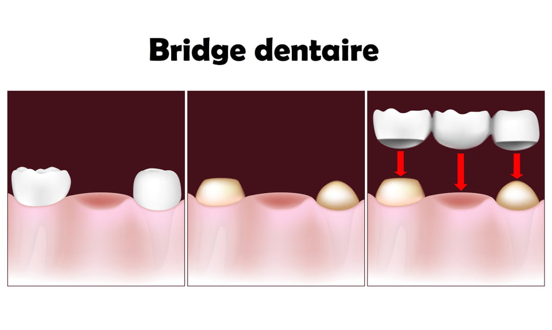 Bridge Dentaire Indication Retrait Prix Remboursement Bridge Dentaire Indication Retrait Prix Remboursement