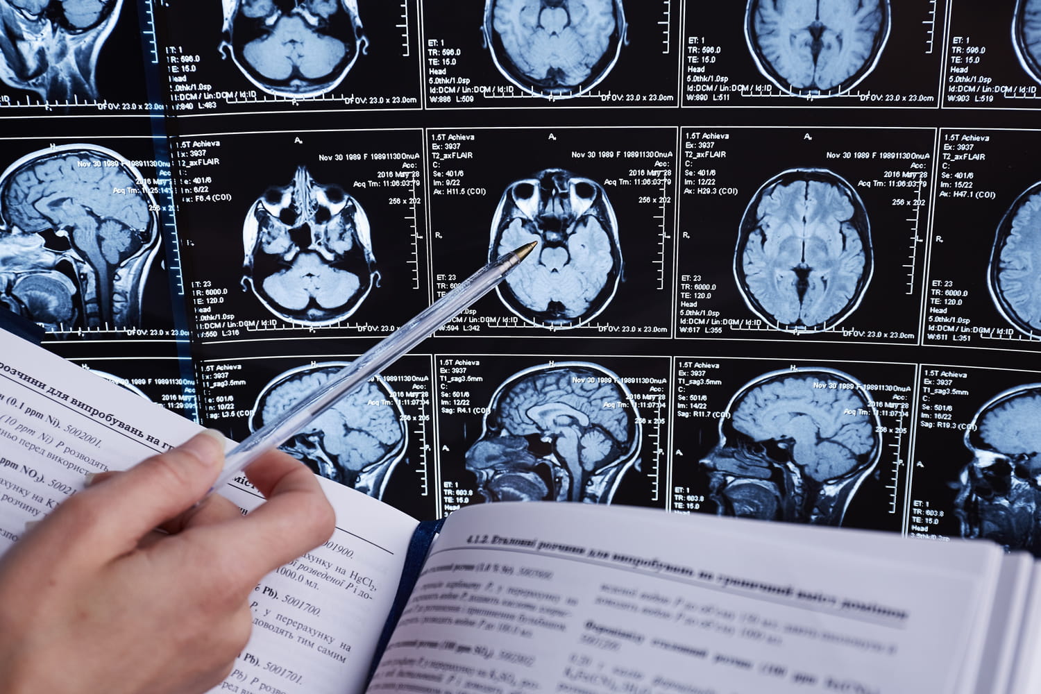 AVC hémorragique : c'est quoi cet AVC rare, quels signes ?