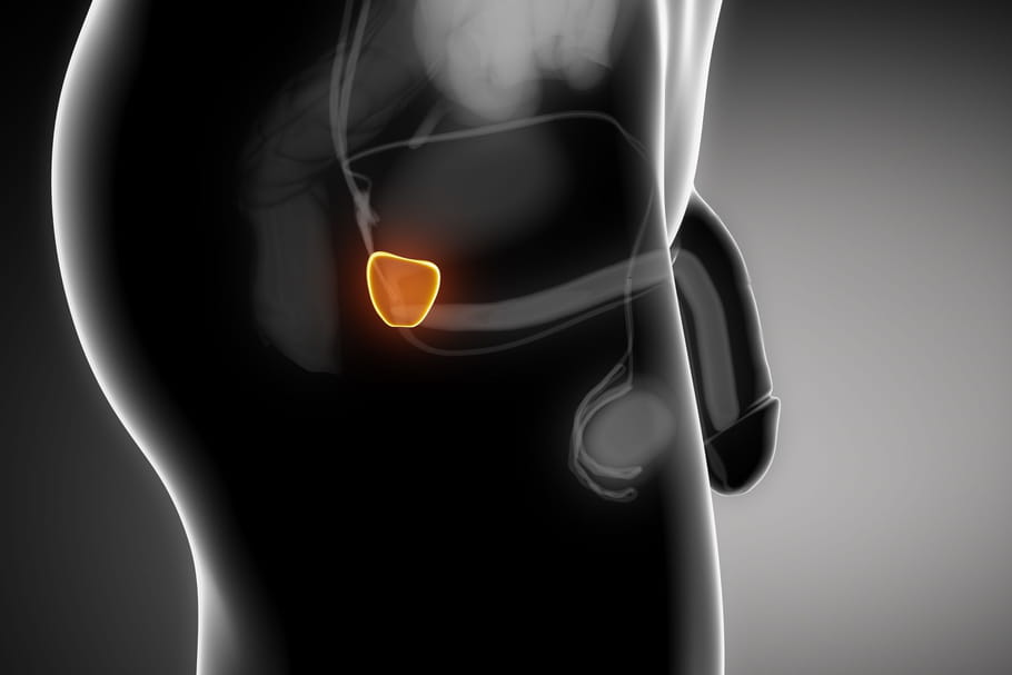 Ablation de la prostate : conséquences, risques, indications ?