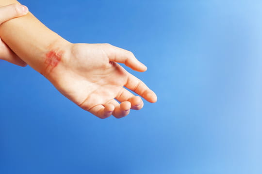 Br&ucirc;lure&nbsp;: types, que mettre sur la peau pour la soigner&nbsp;?