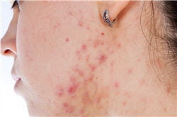 les premiers boutons apparaissent sur le front puis descendent sur le visage, au