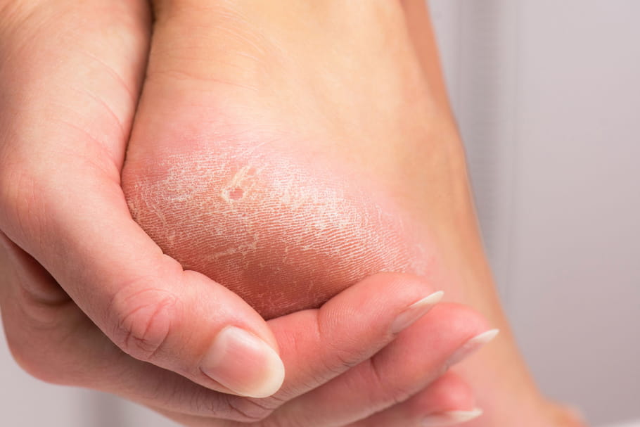 Induration : causes, nodule, après un vaccin, traitements