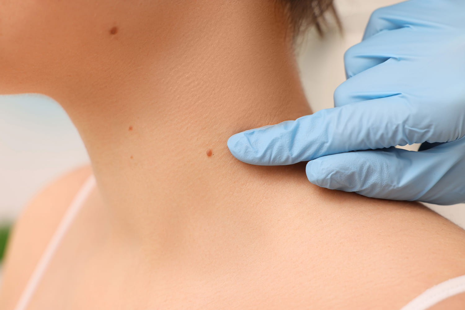It is the simple technique of doctors to find out if a beauty grain hides cancer