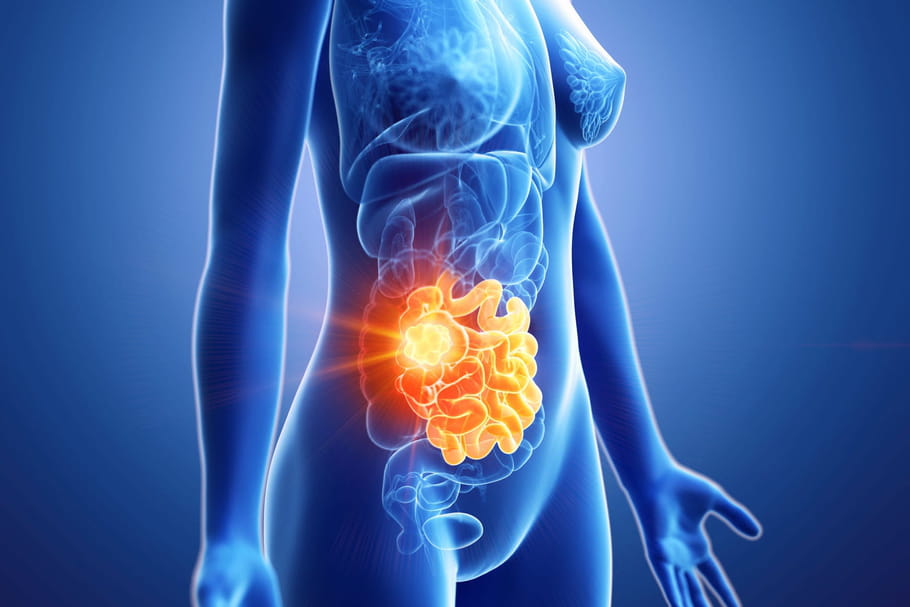 Cancer secondaire : symptômes, traitement, quelle espérance de vie ?