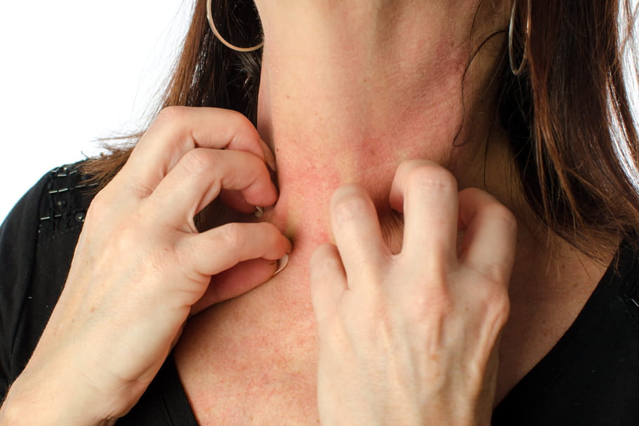 Dermite séborrhéique : symptômes et traitements du visage, des cheveux