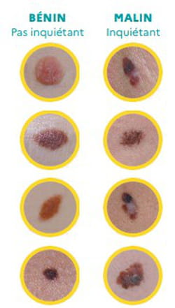 Règle ABCDE cancer de la peau