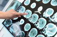 Tumeur maligne ou bénigne : définition, différence et symptômes