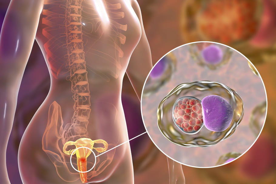 Cervicite : symptômes, causes, quels traitements ?
