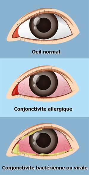 conjonctivite yeux allergie virale bactérienne