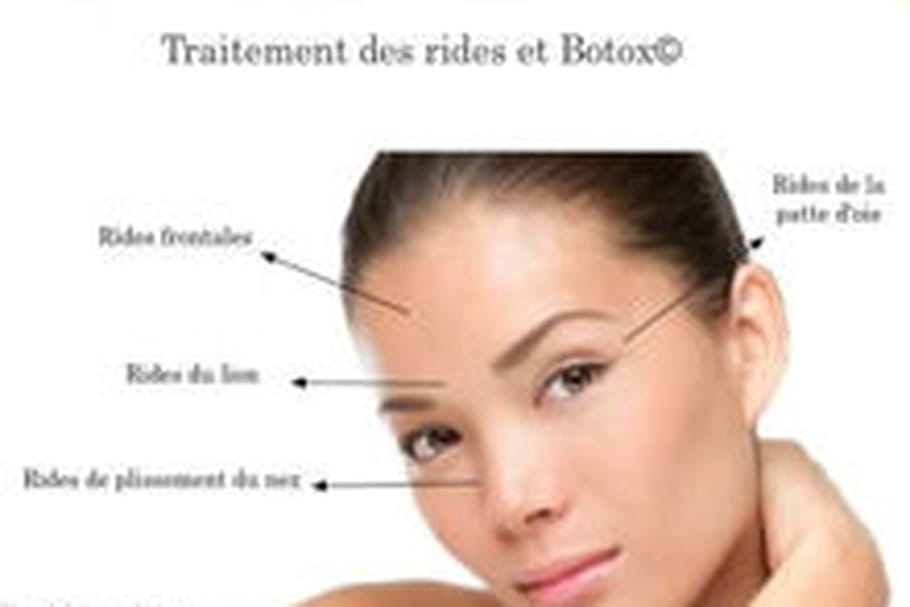 Les injections de Botox®