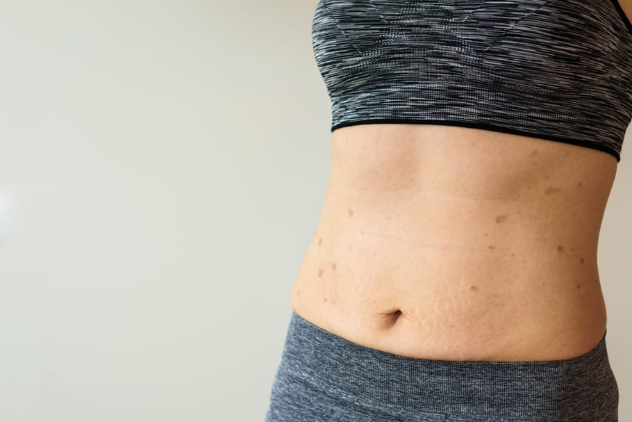 Lichen plan : cutané, buccal, pilaire, quels traitements ?