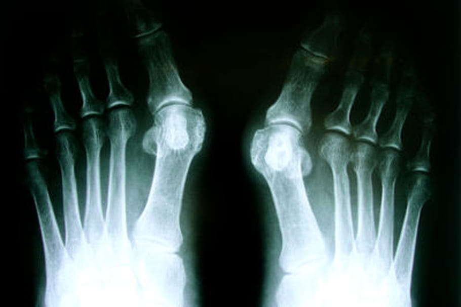 Hallux valgus : causes et traitements