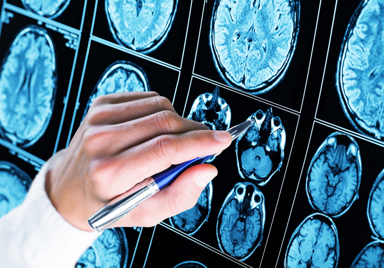 Démence fronto-temporale : signes, cause, test, lien avec Alzheimer ?