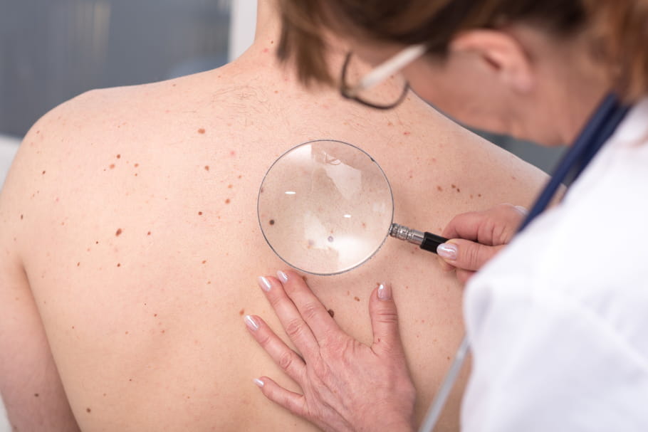 Mélanome de la peau : ça ressemble à quoi ?