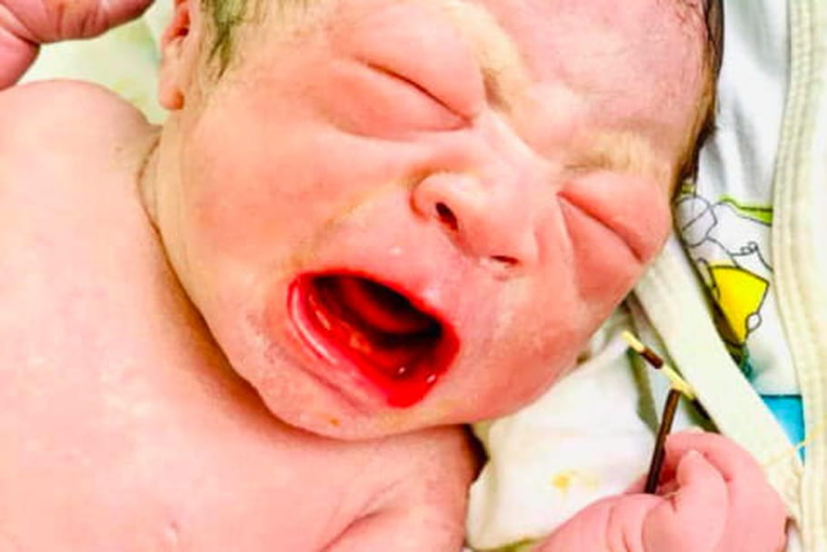 Au Vietnam, un bébé naît avec le stérilet de sa mère à la main