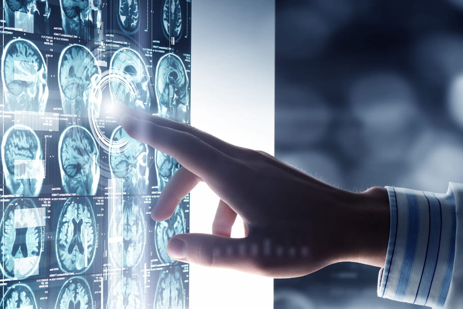 Atrophie cérébrale : symptômes, causes, lien avec Alzheimer, traitement