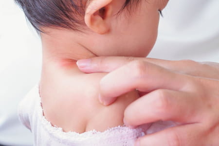 piqûre de moustique sur la peau d'un enfant