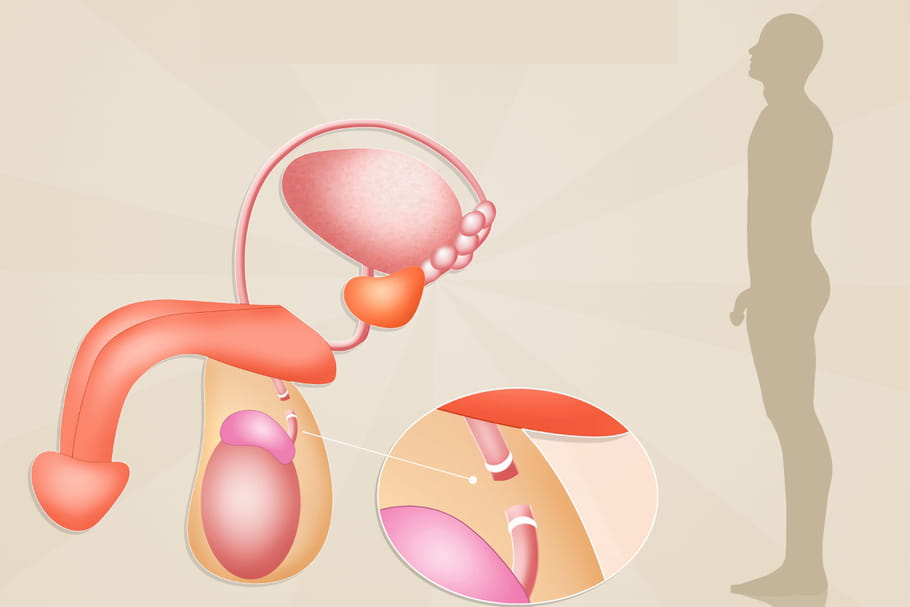 Vasectomie : douleur, prise de poids, quels effets secondaires ?