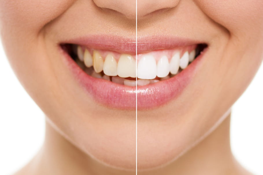 Comment se blanchir les dents
