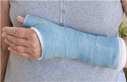 une fracture ostéoporotique pourrait être le signe d'une santé précaire.