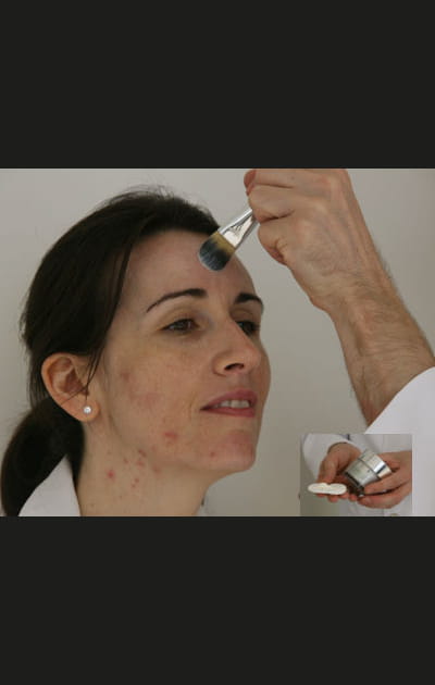 Camoufler ses boutons&nbsp;: le soin anti-&acirc;ge